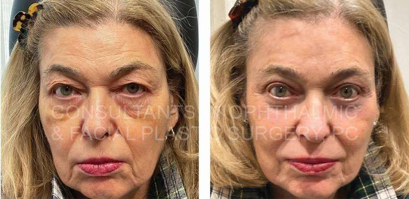 Endoscopic Forehead and Brow Lift / Repair Ptosis Both Upper Lids / Transconjunctival Excision Herniated Orbital Fat with Co2 Laser Skin Resurfacing of Both Lower Lids / Blepharoplasty of Both Upper Lids