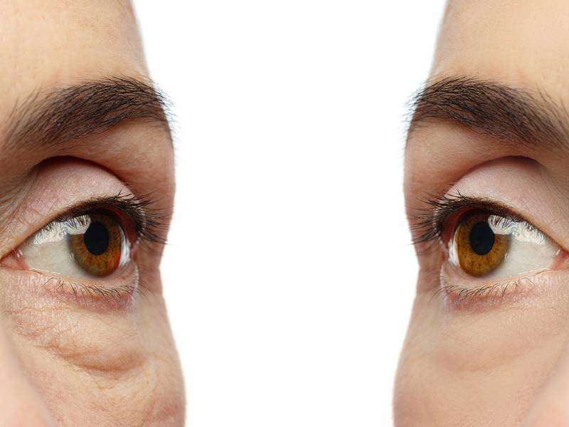 Is Eye Bag Surgery Right For Me?