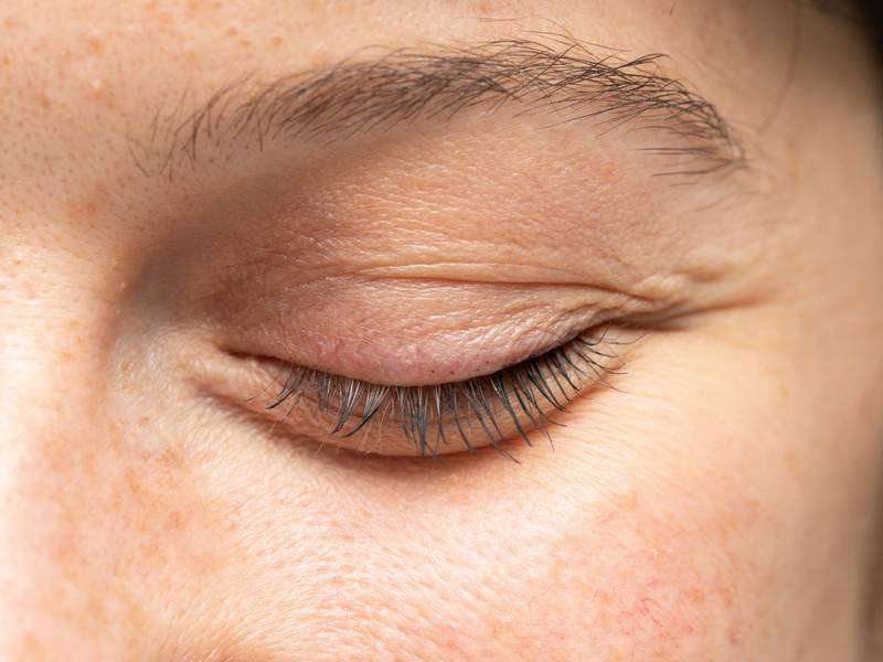 What is Entropion Eyelid Reconstruction?