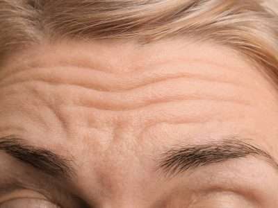 What Are the Benefits of a Forehead Lift?