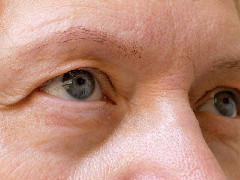 What Are Top Eyelid Drooping Treatments?