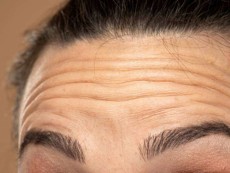 How Can I Prevent Wrinkles on My Forehead?