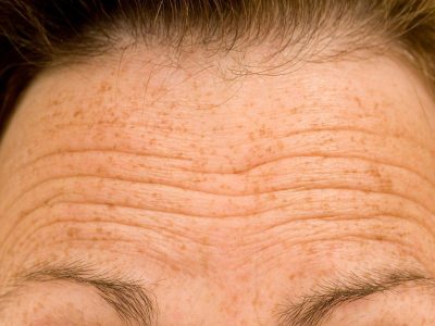 Who Can Help Reduce Wrinkles on Forehead Near Dearborn, MI?