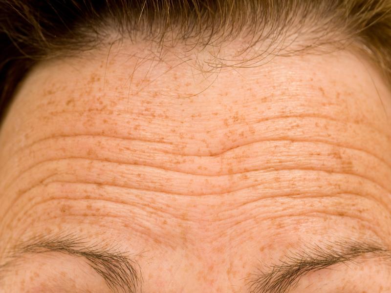 Who Can Help Reduce Wrinkles on Forehead Near Dearborn, MI?