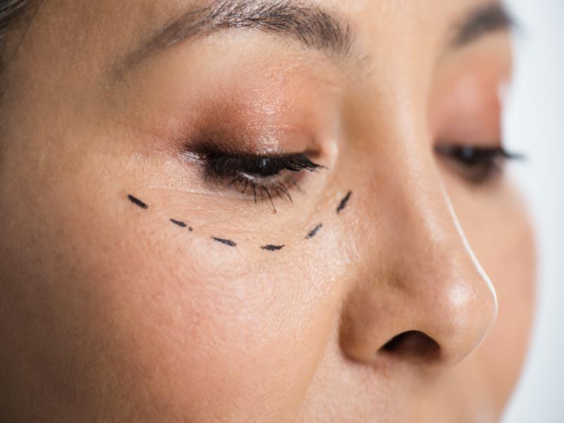 What Are the Different Types of Eye Bag Surgery?