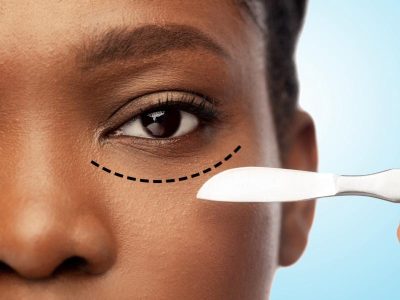 What Should I Expect for My Eye Bag Surgery Recovery Timeline?
