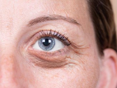 What Should You Know About the Anatomy Behind Eye Bag Surgery?