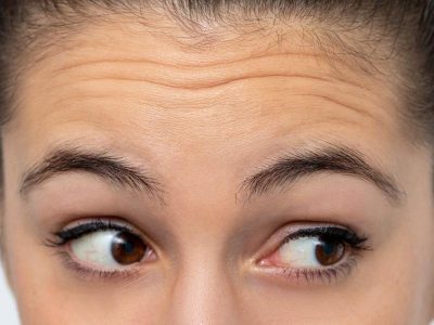 What Are the Non-Surgical Alternatives for Mild Wrinkles on Forehead?