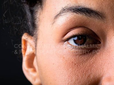 Can Tear Duct Surgery Help Reduce Dark Circles?