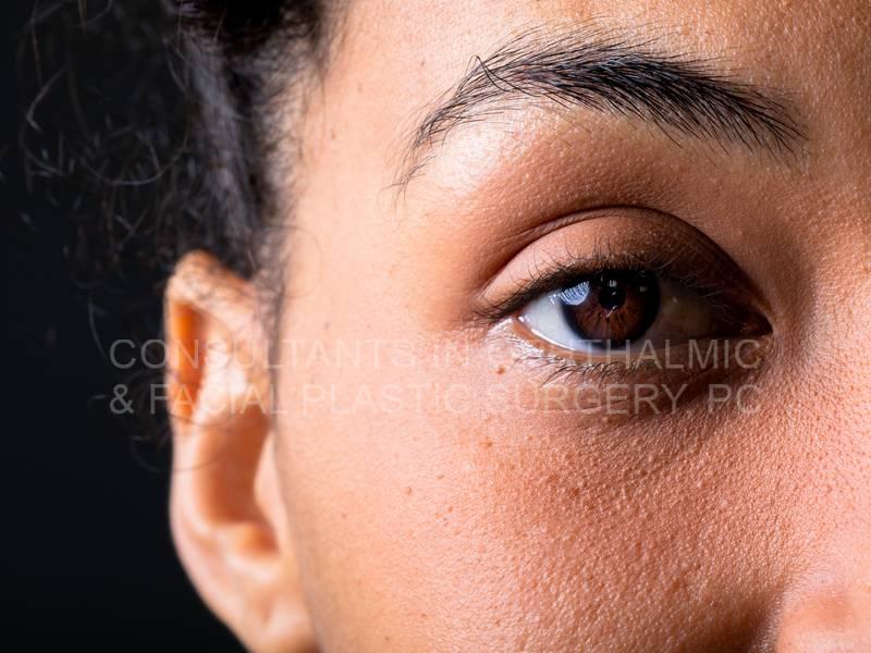 Can Tear Duct Surgery Help Reduce Dark Circles?