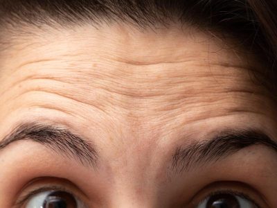 What Is The Ideal Age to Get a Professional Forehead Lift?