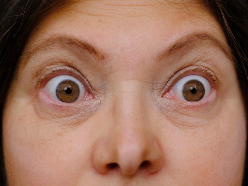 Can Bulging Eyes Thyroid Be Permanently Corrected?