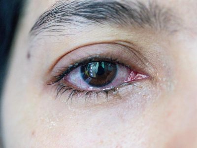 Can a Blocked Tear Duct Go Away on Its Own?