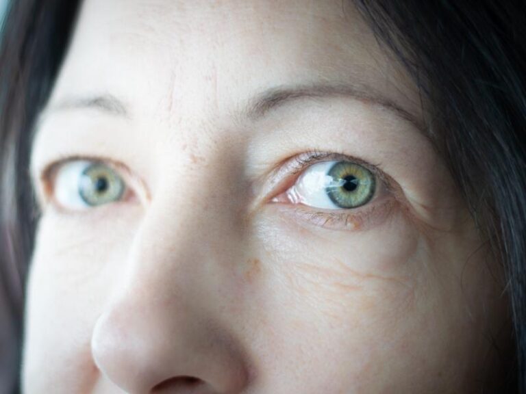 Are Bulging Eyes Thyroid Related to Thyroid Disease?