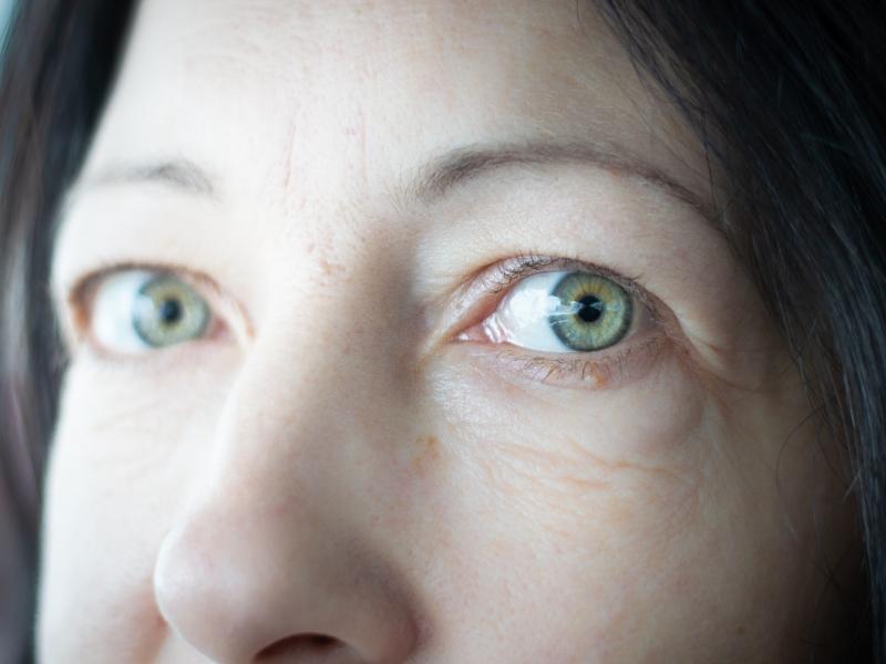 Are Bulging Eyes Thyroid Related to Thyroid Disease?