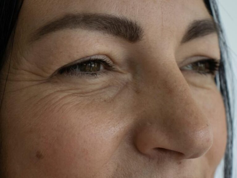 Eye Bag Surgery vs. Fillers: Which Option Is Right for You?