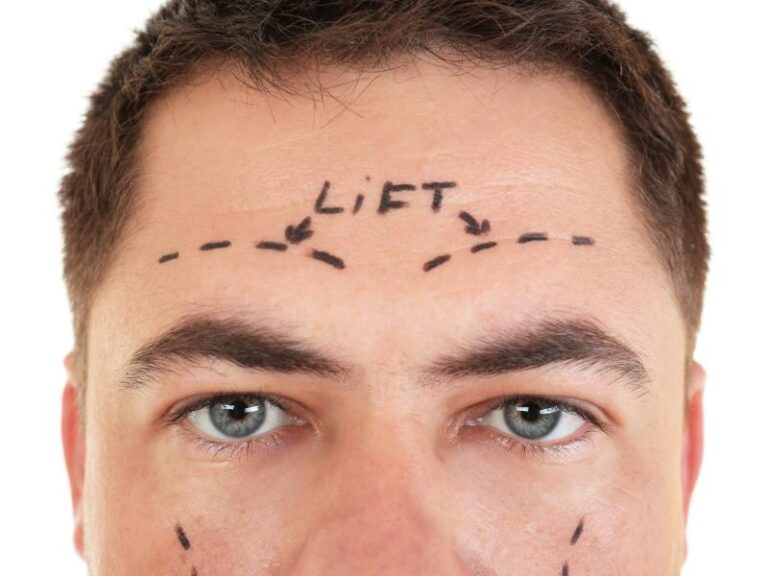 How to Prepare for an Eyebrow Lift Procedure