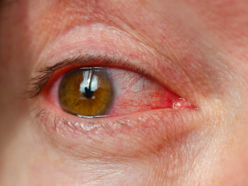 Tear Duct Surgery: What Causes Chronic Tearing in Adults?