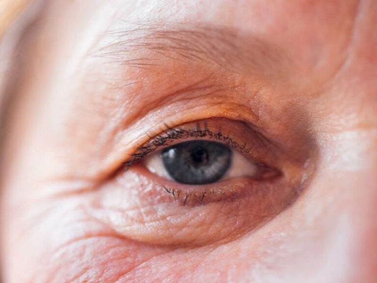 Is Eyebag Surgery Right for You? Signs It’s Time to Consider Treatment