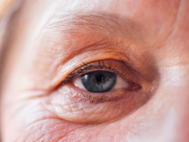 Is Eyebag Surgery Right for You? Signs It’s Time to Consider Treatment