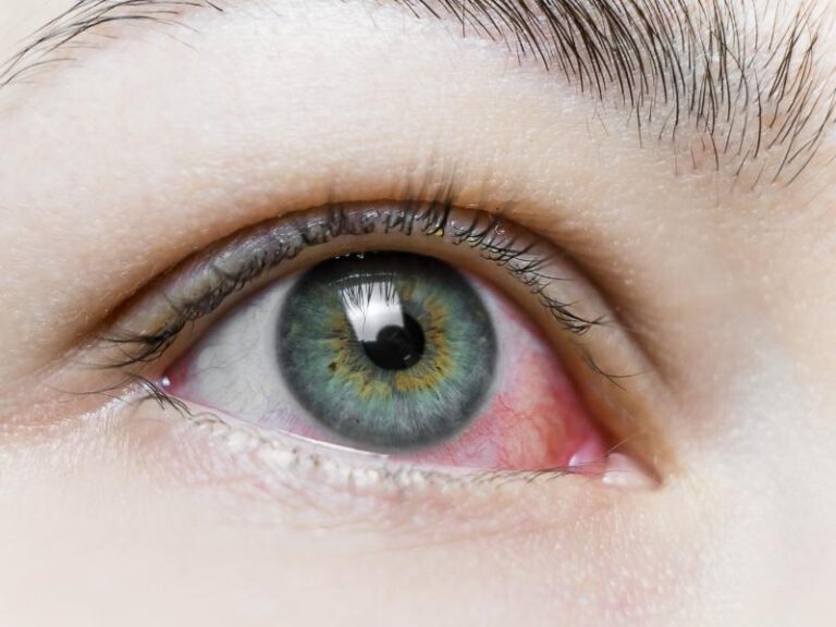 When Should You Seek Treatment for Ectropion Eye?