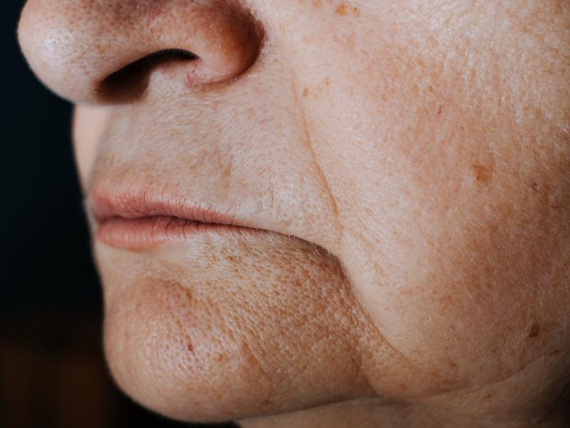 Skin Tightening Treatment Starts Long Before You Notice Loose Skin