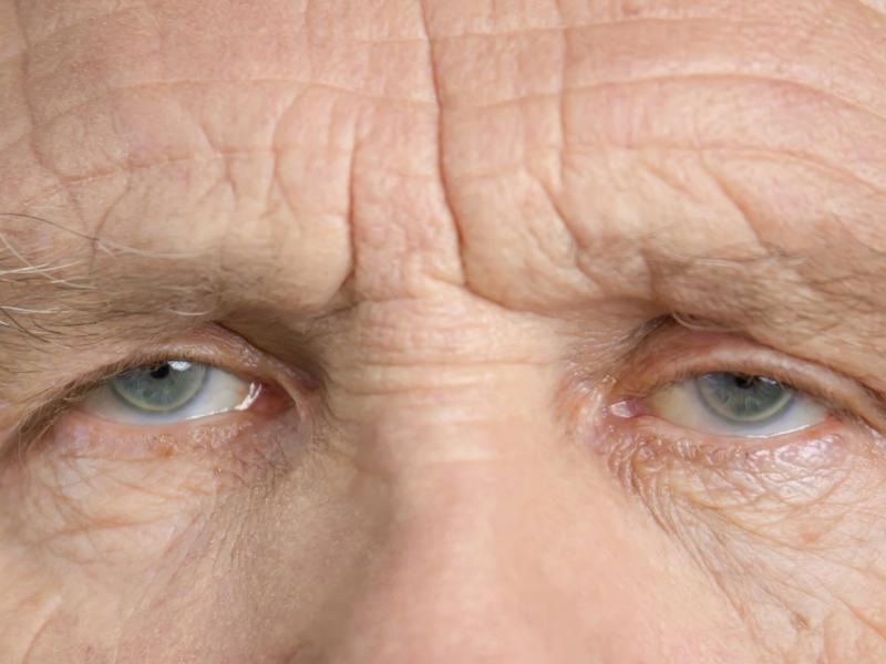 Wrinkles on Forehead: When Do They Become a Cosmetic Concern?