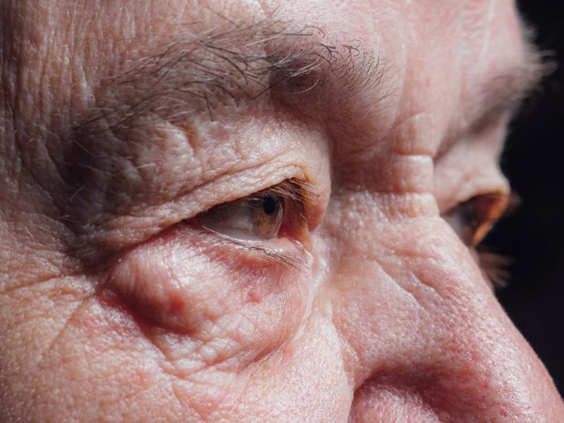 An Ectropian Eye May Change More Than Your Eyelid Position