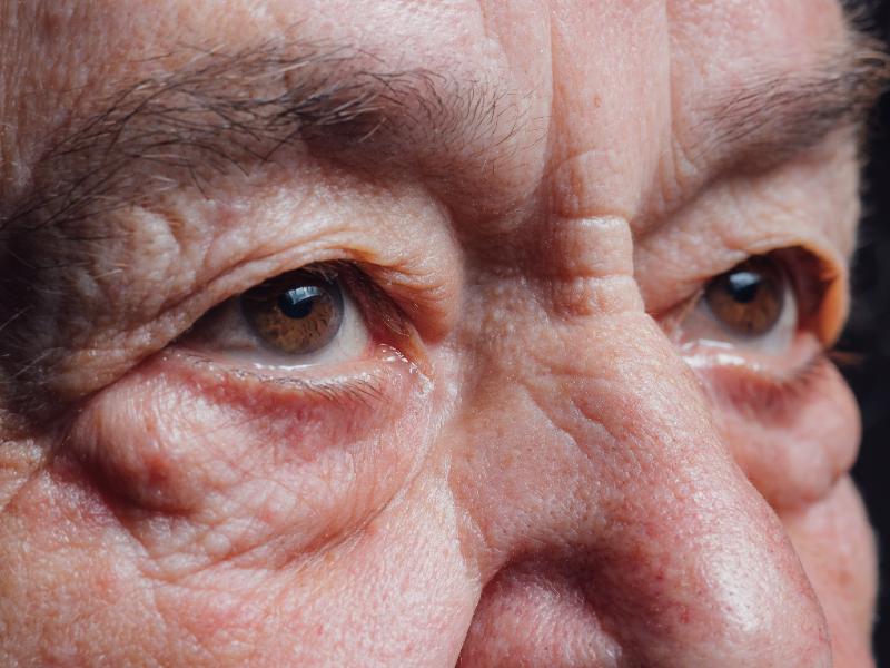 Age-Related Brow Changes Can Affect the Entire Eye Area in Livonia, MI