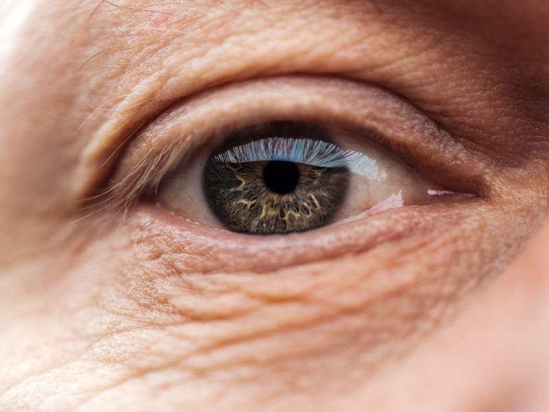 An Outward-Turning Eyelid May Signal Ectropion Eye in Flint, MI