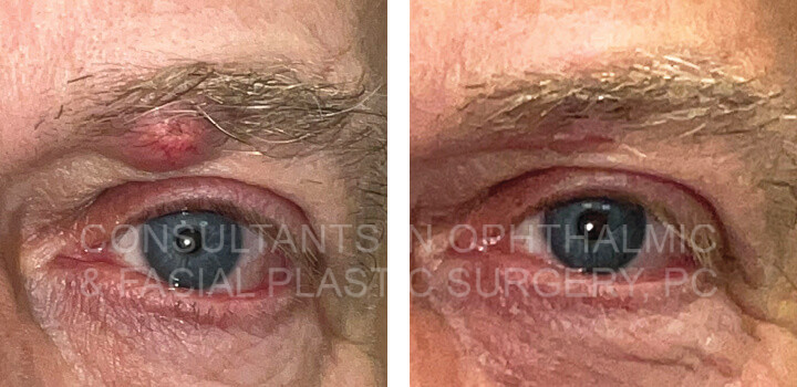 Excision lesions left subbrow and left upper lid