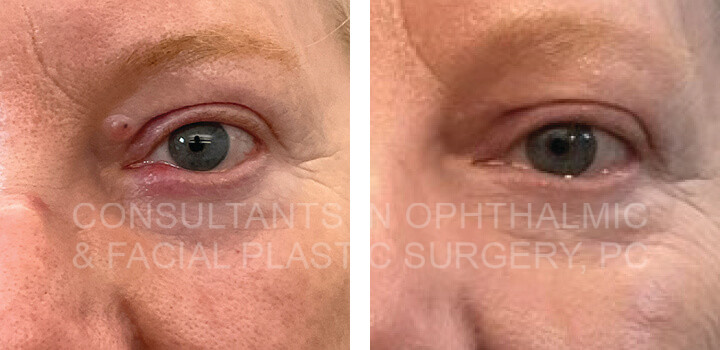 Lesion excision, left upper lid