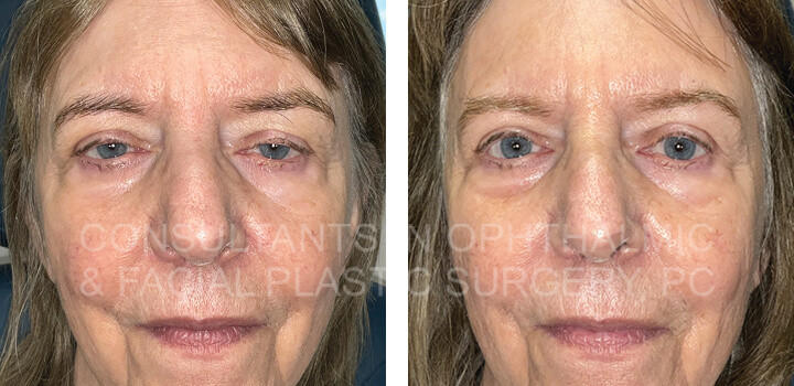 Repair ptosis both upper lids