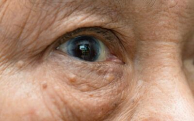 Address Persistent Under-Eye Bags With Eye Bag Surgery in Southgate, MI