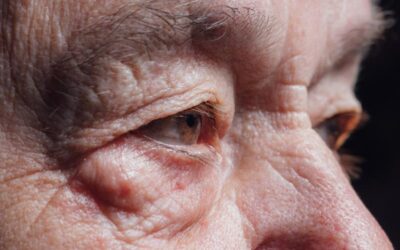 An Ectropian Eye May Change More Than Your Eyelid Position