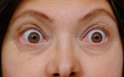 Can Bulging Eyes Thyroid Be Permanently Corrected?