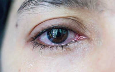 Can a Blocked Tear Duct Go Away on Its Own?