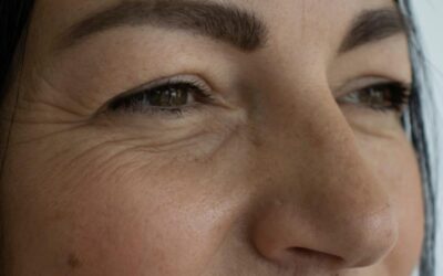 Eye Bag Surgery vs. Fillers: Which Option Is Right for You?