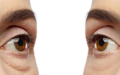 Is Eye Bag Surgery Right For Me?