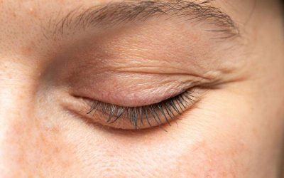 What is Entropion Eyelid Reconstruction?