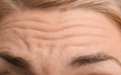 What Are the Benefits of a Forehead Lift?