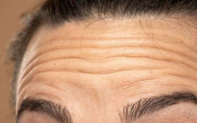 How Can I Prevent Wrinkles on My Forehead?