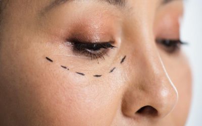 What Are the Different Types of Eye Bag Surgery?