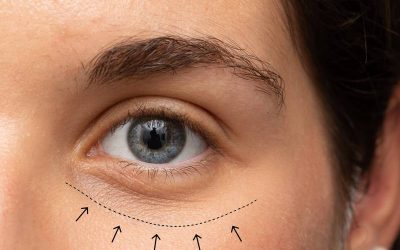 3 Ways Eye Bag Surgery Boosts Your Confidence