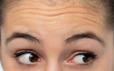 What Are the Non-Surgical Alternatives for Mild Wrinkles on Forehead?