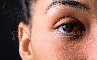 Can Tear Duct Surgery Help Reduce Dark Circles?