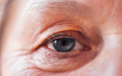 Is Eyebag Surgery Right for You? Signs It’s Time to Consider Treatment