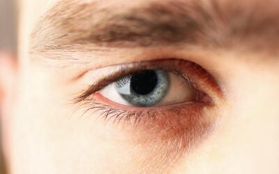Living With Blocked Tear Ducts? Here’s What to Know