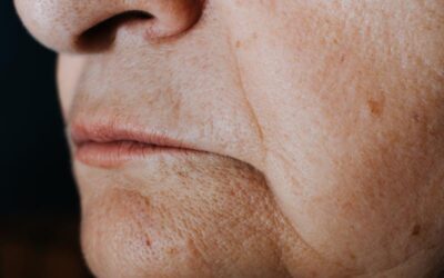 Skin Tightening Treatment Starts Long Before You Notice Loose Skin