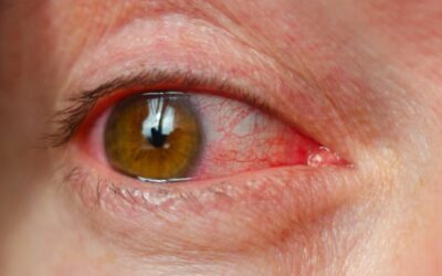 Tear Duct Surgery: What Causes Chronic Tearing in Adults?